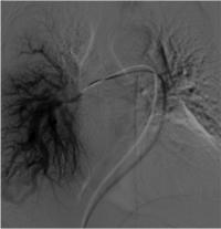 Hereditary Hemorrhagic Telangiectasia (HHT) scan